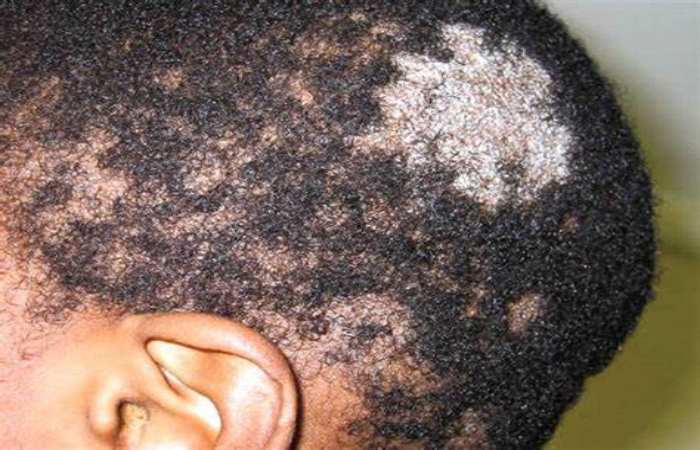 Tinea Capitis (Fungal Contamination of The Scalp)