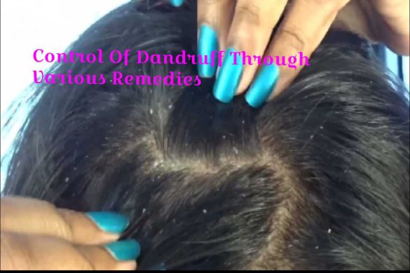 Control Of Dandruff Through Various Remedies